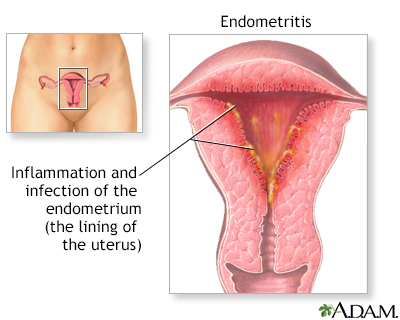Endometritis - UF Health