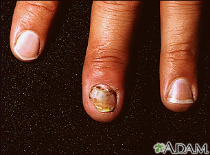 Green Nail Syndrome - American Osteopathic College of Dermatology (AOCD)