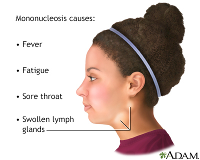 Symptoms of Mononucleosis