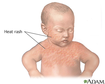 Babies and heat rashes - UF Health