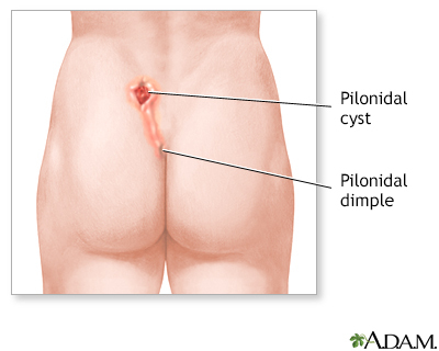Pilonidal disease - Wikipedia