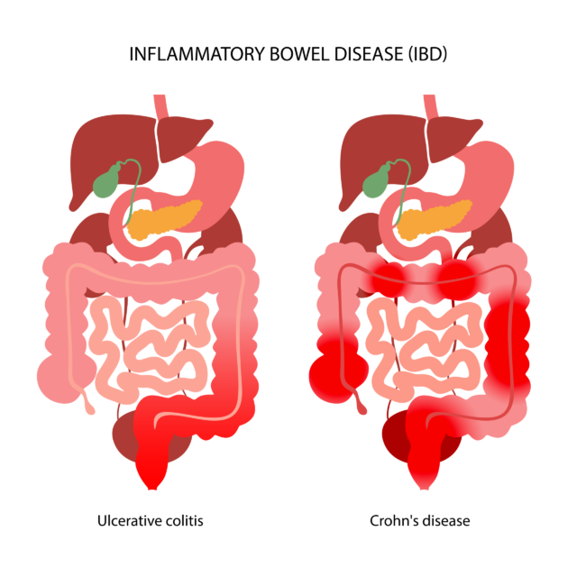 Illustration of ulcerative colitis and Crohn’s disease