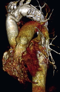3d image of reconstructed aorta