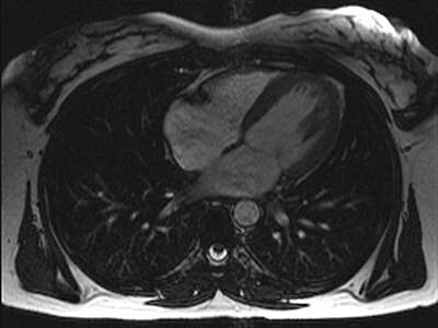 MRI scan of a heart