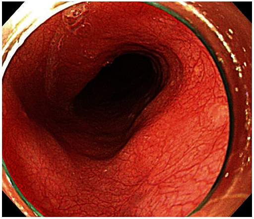 On esophagogastroduodenoscopy after endoscopic submucosal dissection, there is no evidence of recurrence or metastasis.