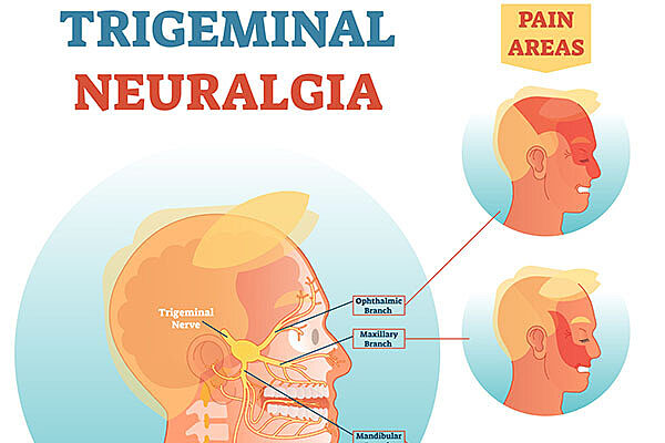 Trigeminal neuralgia infographic