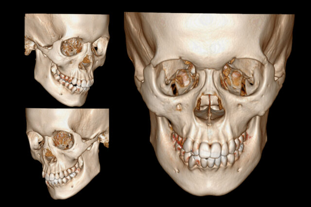 Profile, three-quarter and front-facing image collage of a 3d modeled skull