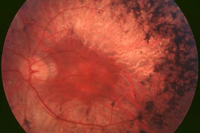 Eye therapy illustration