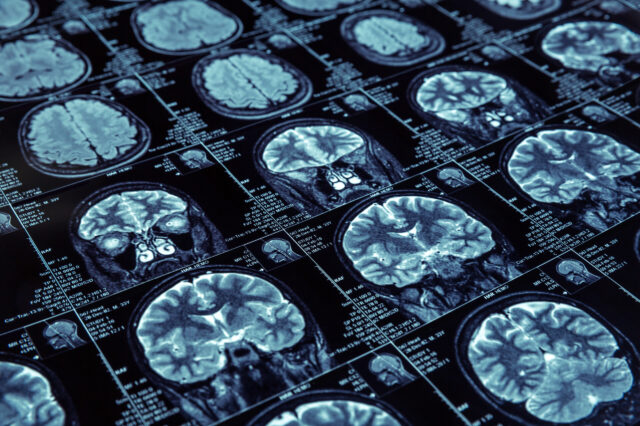 A computer screen displays the brain MRIs of several individuals. This image is not related to the UF Health brain aging study. (Getty Images.)