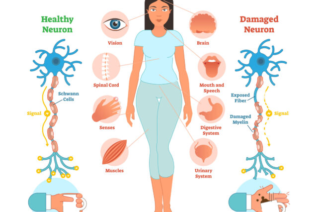 Multiple sclerosis infographic