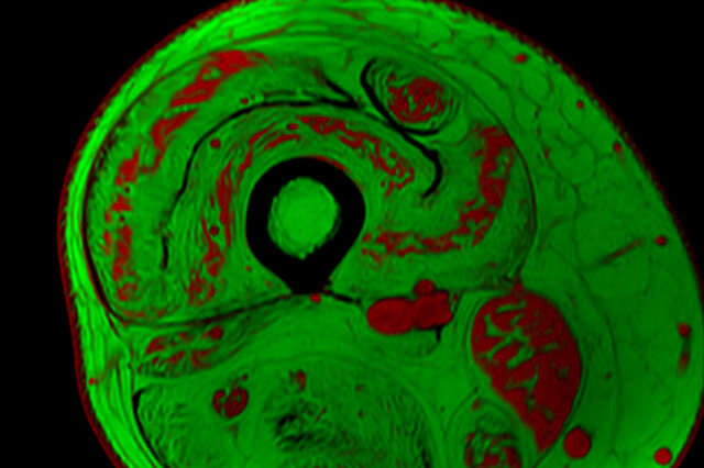 A UF magnetic resonance image shows a cross section of thigh muscle of a person with muscular dystrophy. The swirls of red indicate muscle tissue while the green depicts areas where fat has replaced muscle. Credit: Glenn Walter.