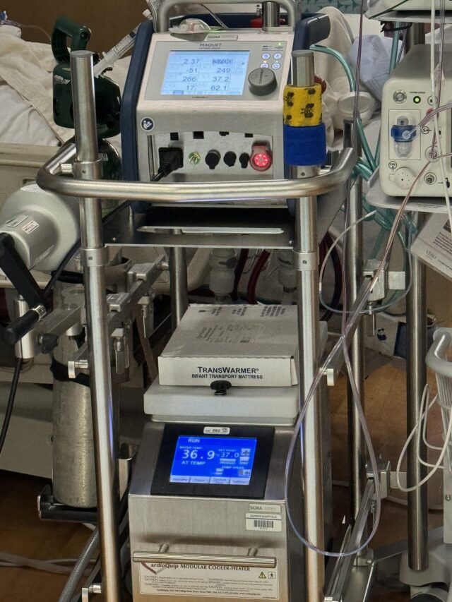 An extracorporeal membrane oxygenation machine, also known as ECMO.