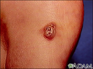 sarcoma cancer de piel cell papilloma of skin