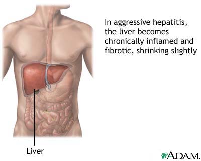 Chronic hepatitis
