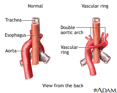 Vascular ring