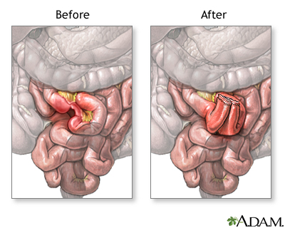 Intestinal obstruction repair | UF Health, University of ... diagram of cecal volvulus 