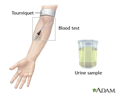 17 hydroxycorticosteroid test