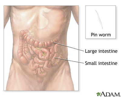 Pinworms fejlődési stádiuma, Mi az a pinworms (enterobiosis)?