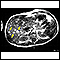 Melanoma of the liver - MRI scan