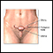 Pelvic laparoscopy - series