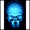 Eosinophilic granuloma - X-ray of the skull