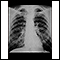 Coal worker's lungs - chest x-ray