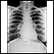 Sarcoid, stage I - chest X-ray