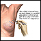 Open biopsy of the breast