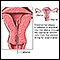 Endometrial biopsy