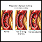 Progressive build-up of plaque in coronary artery