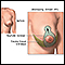 Breast lift (mastopexy) - series - Incisions