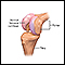 Partial knee replacement - series
