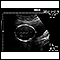 Ultrasound, normal fetus - head measurements
