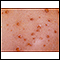 Chickenpox - close-up