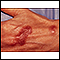 Mycobacterium marinum infection on the hand