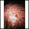 Actinic keratosis on the scalp
