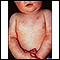 Dermatitis - atopic in an infant