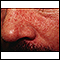Dermatitis, seborrheic - close-up