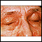 Dermatomyositis - heliotrope eyelids