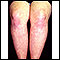 Dermatomyositis on the legs