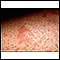 Eczema, atopic - close-up