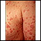 Psoriasis - guttate on the arms and chest