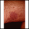 Kaposi sarcoma on the thigh