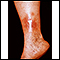 Dermatitis - stasis on the leg