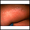 Lichen striatus on the leg