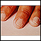 Kawasaki's disease - peeling of the fingertips