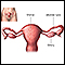 Tubal ligation - uterine anatomy