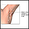 Swollen lymph nodes under arm