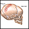 Infant skull fracture