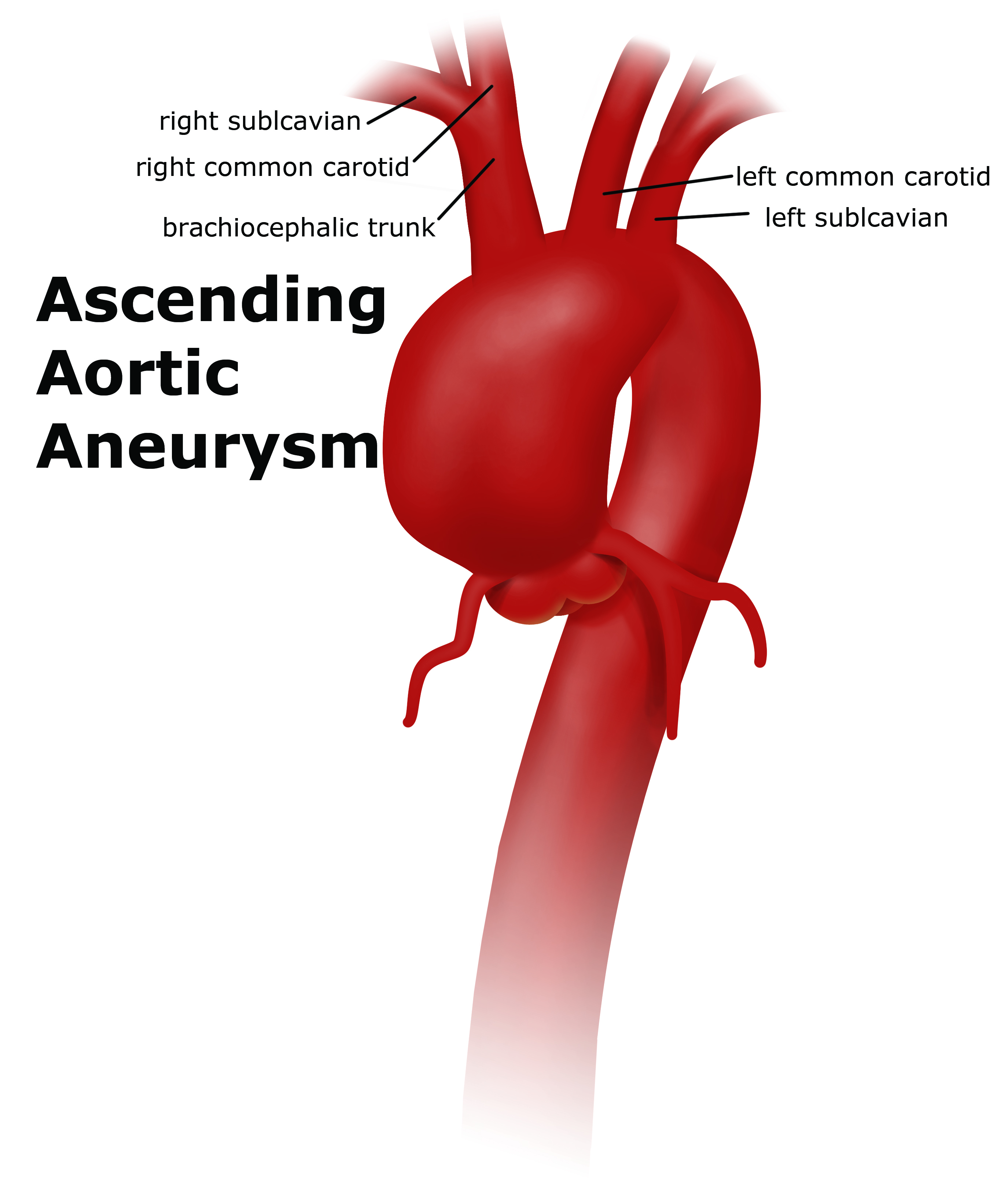 Thoracic Aortic Aneurysm | UF Health Aortic Disease Center|Diseases ...